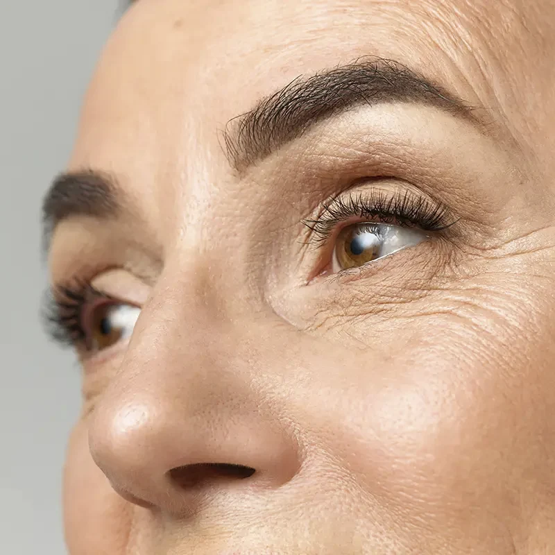 Arrugas de expresión